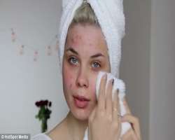 She has suffered from acne for one year after losing weight She has suffered from acne for one year after losing weight.
